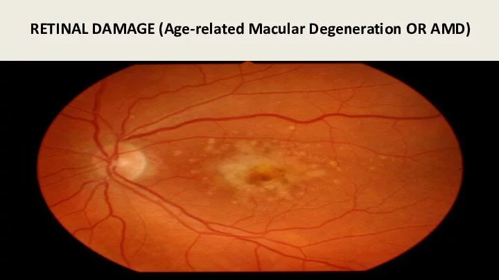Eye damage in the form of age related macular degeneration (AMD).